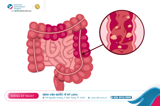 COLON POLYPS – THE “SILENT TUMORS” THAT CAN PREVENT CANCER