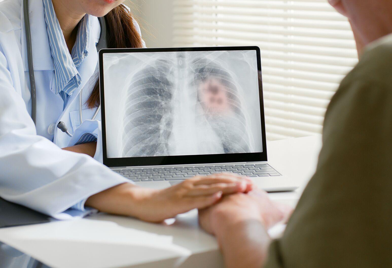 GÓI TẦM SOÁT UNG THƯ PHỔI