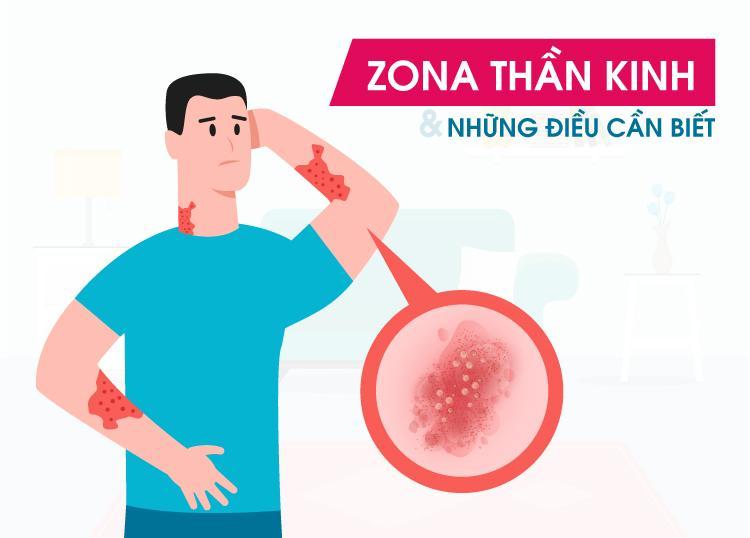 SHINGLES & THINGS YOU NEED TO KNOW
